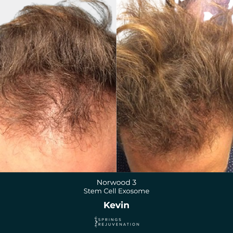 Kevin - Before & After
